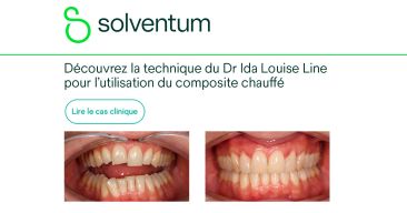 Intérêt du composite chauffé en pratique clinique : cas de restauration directe