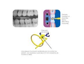 Angulateur Bite-Wings Senso Horizontal Pour Radiographie Interproximale (4)