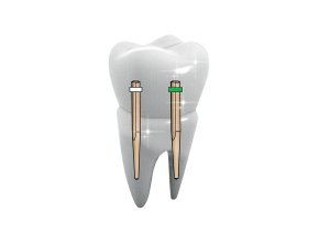 TENONS PEEK-OPTIMA