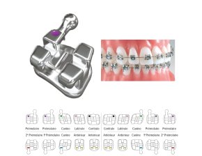 Brackets Maxillaires Votion Méthode MBT