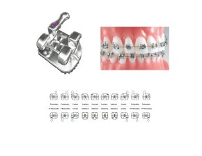 Brackets Maxillaires Pinnacle Méthode MBT