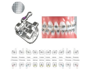 Brackets Mandibulaires Pinnacle Méthode MBT