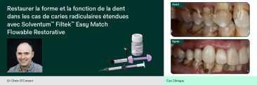 Restaurer la forme et la fonction de la dent dans les cas de caries radiculaires étendues avec Solventum™ Filtek™ Easy Match Flowable Restorative