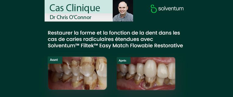 Restaurer la forme et la fonction de la dent dans les cas de caries radiculaires étendues avec Solventum™ Filtek™ Easy Match Flowable Restorative