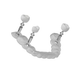 Guide chirurgical implantaire : précision et sécurité en implantologie