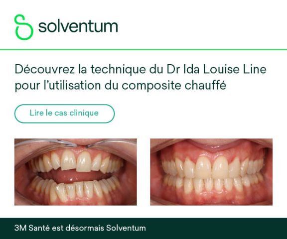 Intérêt du composite chauffé en pratique clinique : cas de restauration directe